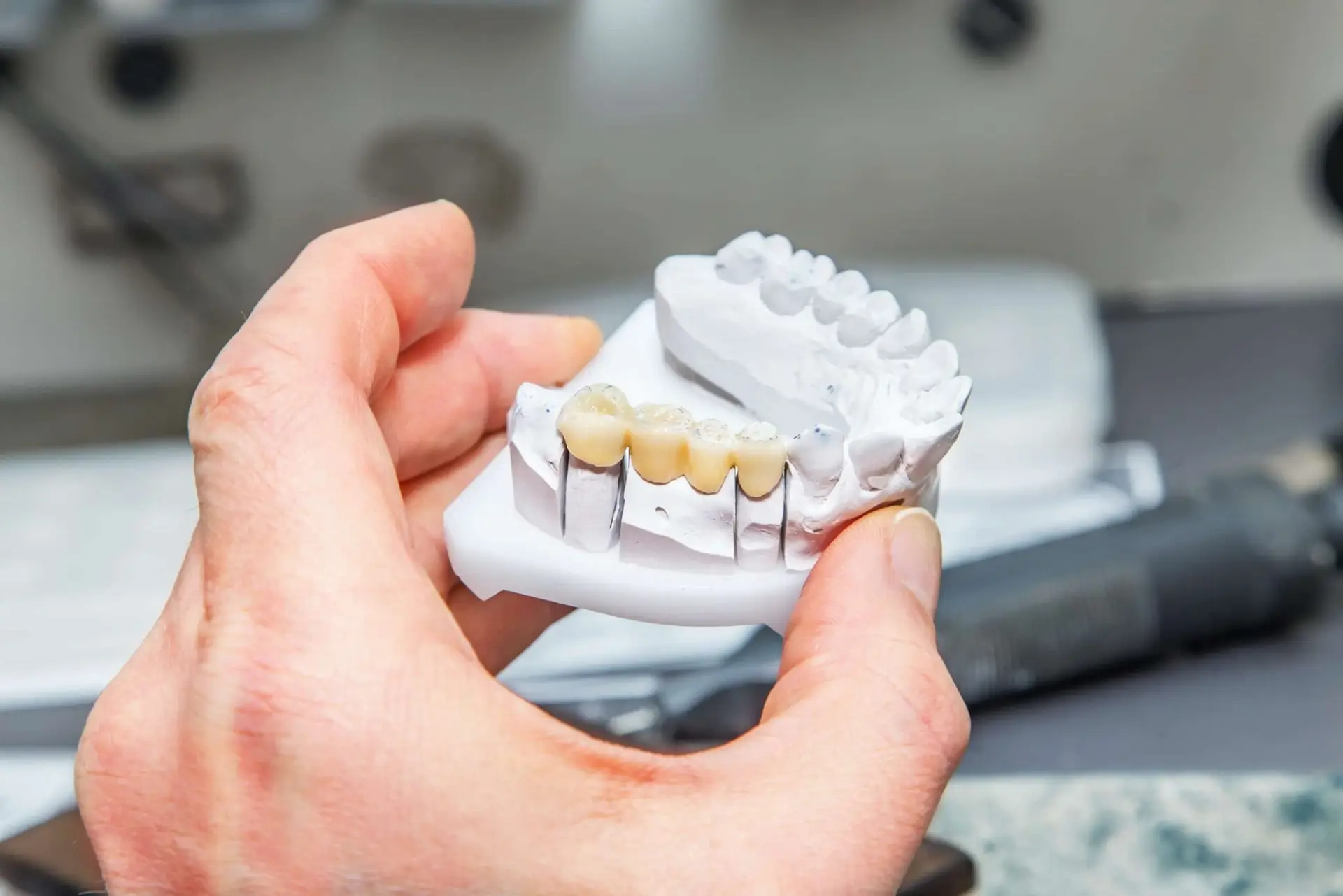 Dental Bridge Model at Cronin Dental Cork