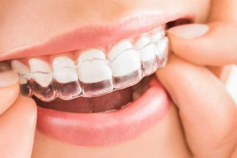 invisalign-770x460-1-2 1